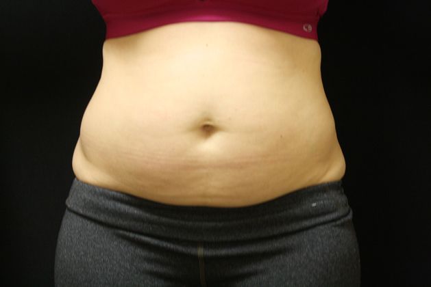 CoolSculpting Case 8 - Before