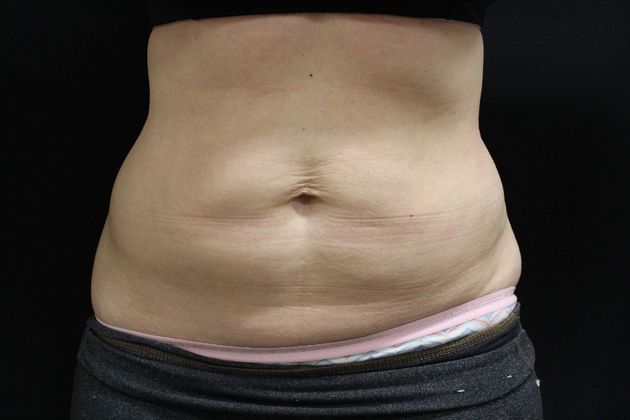 CoolSculpting Case 8 - After