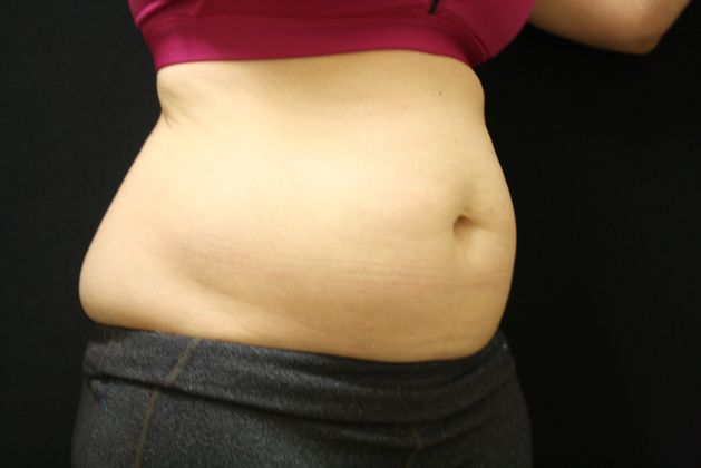 CoolSculpting: Case 8 - Before