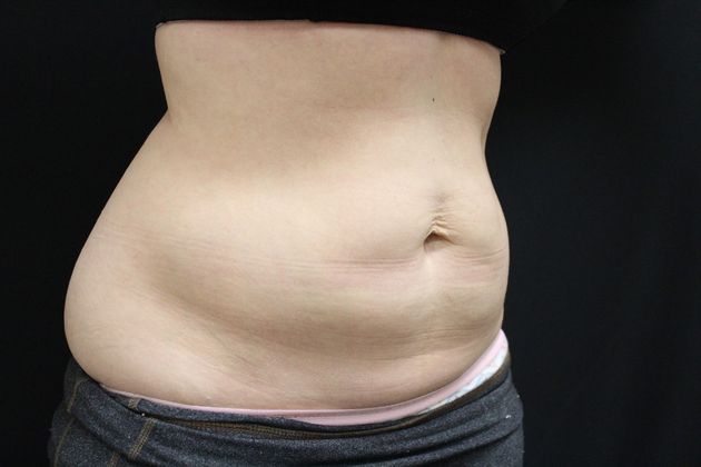 CoolSculpting: Case 8 - After