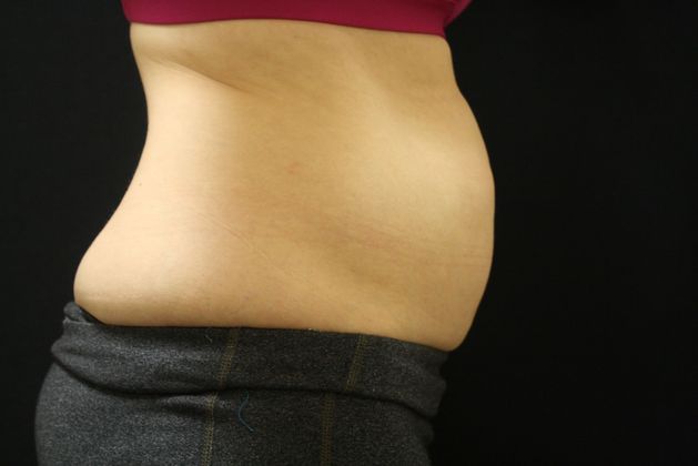 CoolSculpting: Case 8 - Before