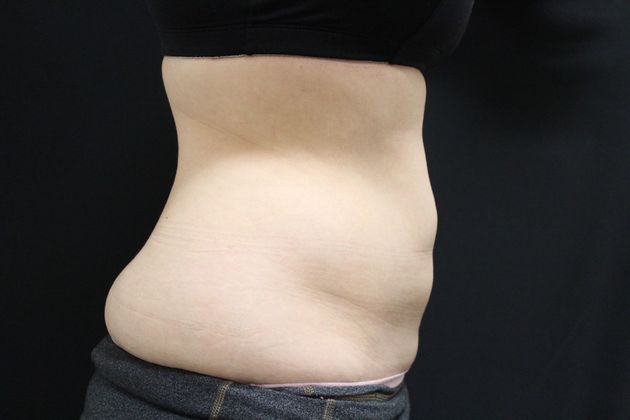 CoolSculpting: Case 8 - After