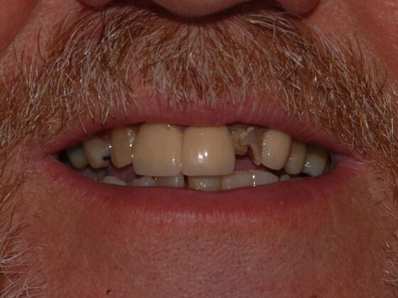 Dentures: Case 2 - Before