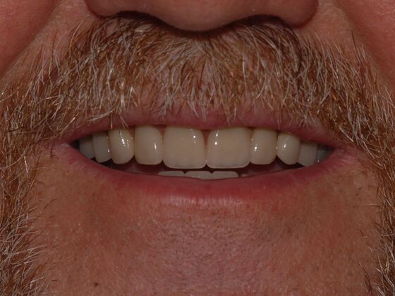 Dentures: Case 2 - After