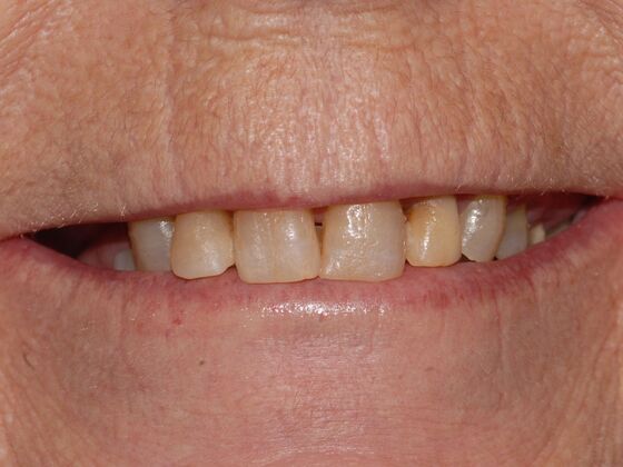 Smile Design Case 2 - Before