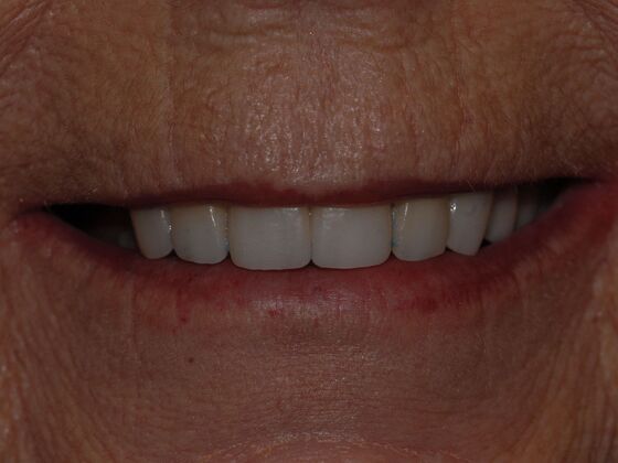 Smile Design Case 2 - After