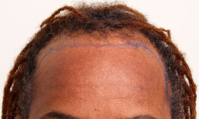 Hair Transplant - Female: Hairline FUT (2) - Before FUT hair transplant