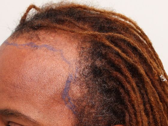 Hair Transplant - Female Hairline FUT (2) - Before