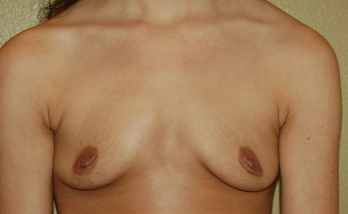 Breast Augmentation Case 242 - Before