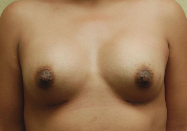 Breast Augmentation Case 244 - After