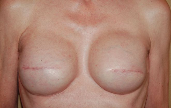 Breast Reconstruction Case 43 - After
