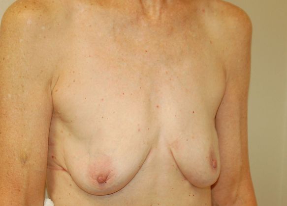 Breast Reconstruction: Case 44 - Before