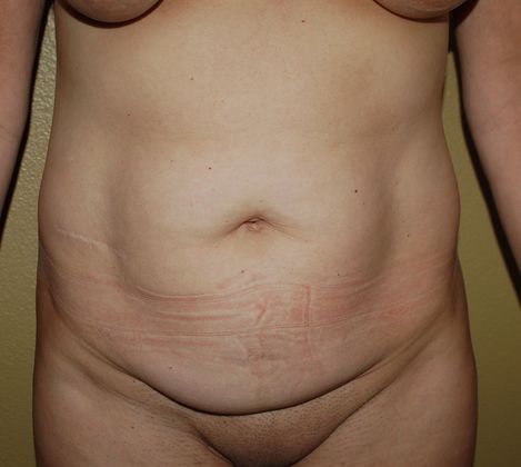 Mommy Makeover Case 42 - After