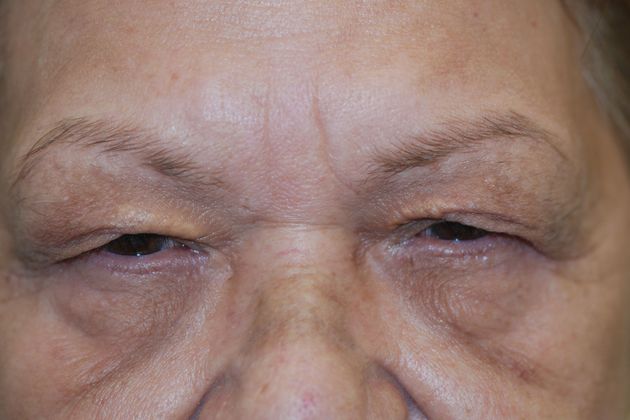 Upper Eyelid Blepharoplasty: Case 29 - Before