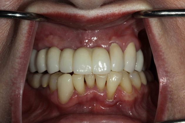 Dental Implants Case 6 - After