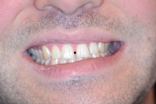 Porcelain Veneers: Patient #8 - Before 