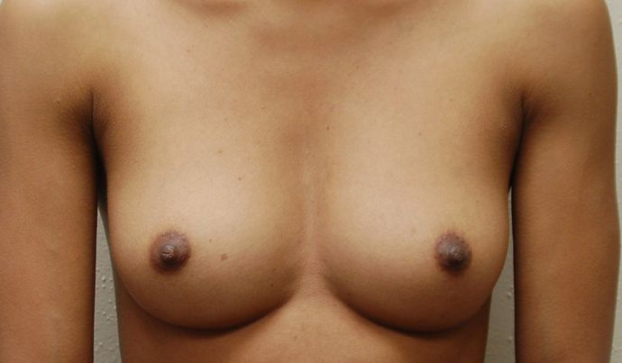 Breast Augmentation Case 249 - Before