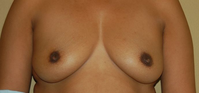 Mommy Makeover Case 45 - Before