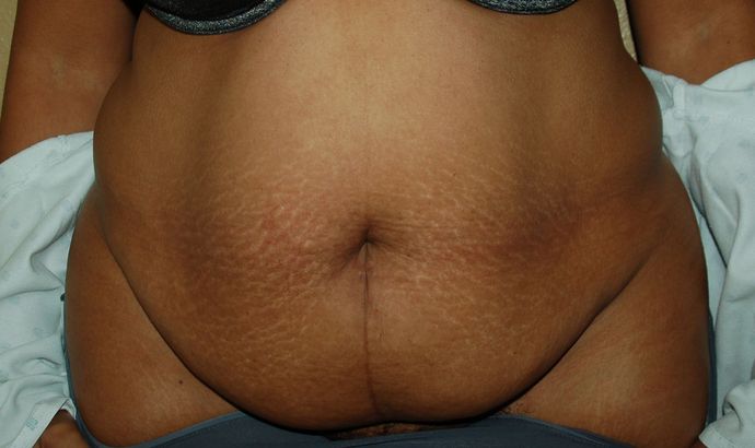 Mommy Makeover Case 45 - After