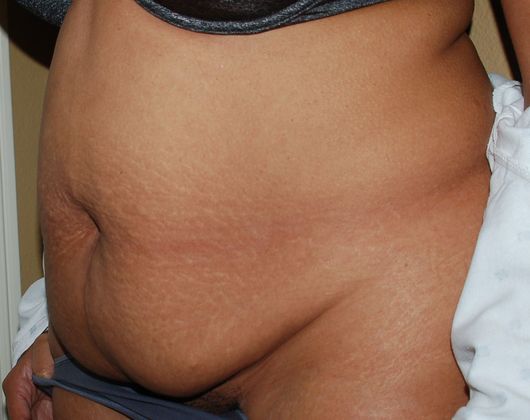 Mommy Makeover: Case 45 - Before