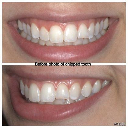 Composite Bonding Cases