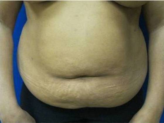 Tummy Tuck: Case 1 - Before