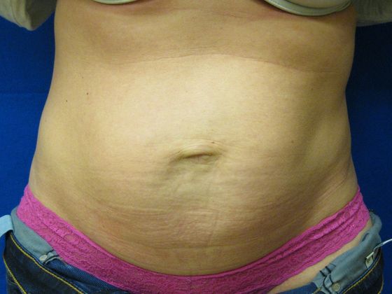 Tummy Tuck: Case 2 - Before