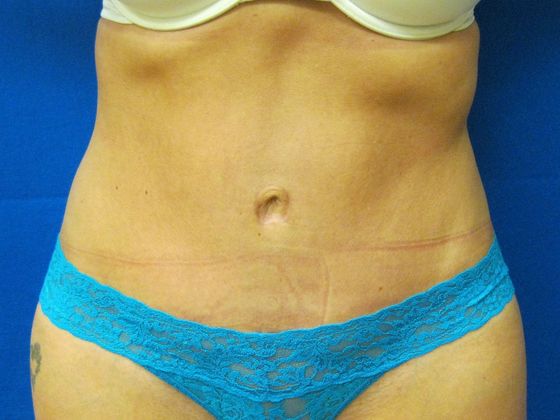 Tummy Tuck Case 2 - After