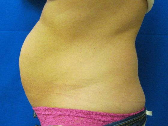 Tummy Tuck: Case 2 - Before