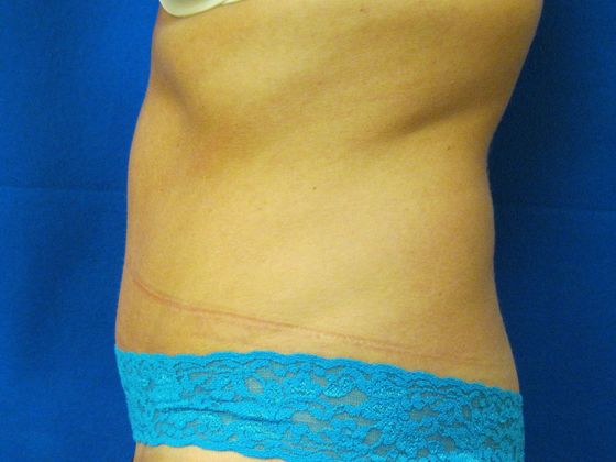 Tummy Tuck: Case 2 - After