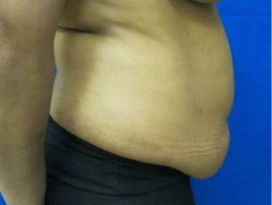 Tummy Tuck: Case 1 - Before