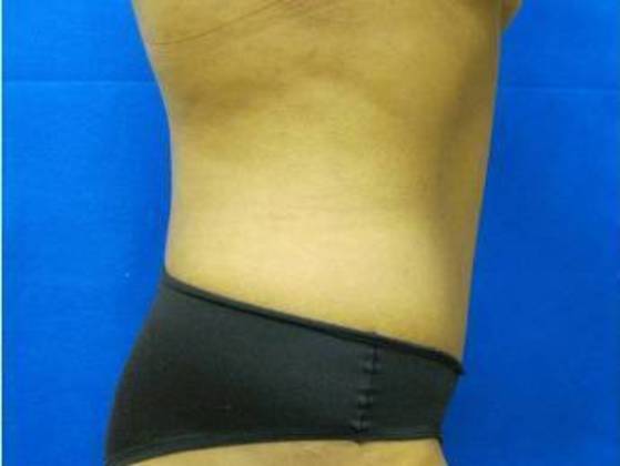 Tummy Tuck: Case 1 - After