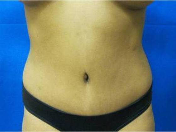Tummy Tuck: Case 1 - After