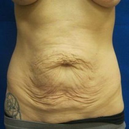 Tummy Tuck: Case 3 - Before