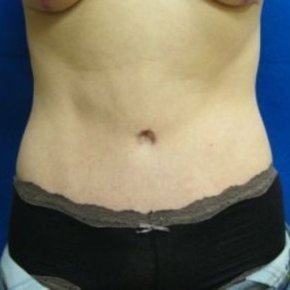 Tummy Tuck: Case 3 - After