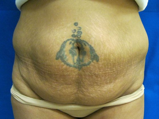 Tummy Tuck Case 4 - Before