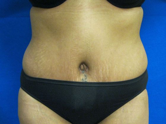 Tummy Tuck Case 4 - After