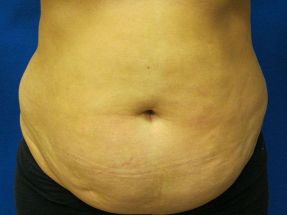 Tummy Tuck: Case 5 - Before