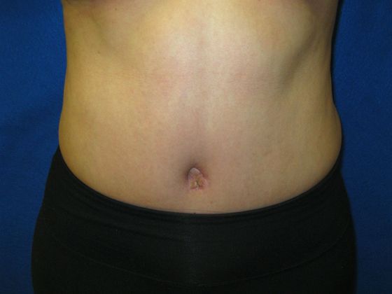 Tummy Tuck: Case 5 - After
