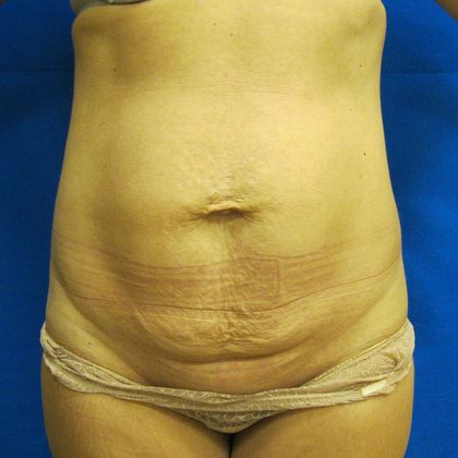 Tummy Tuck Case 6 - Before