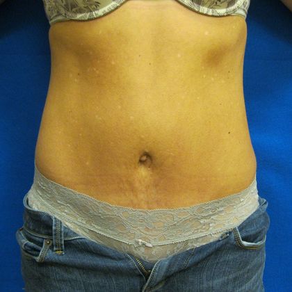 Tummy Tuck Case 6 - After