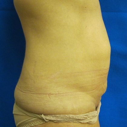 Tummy Tuck: Case 6 - Before