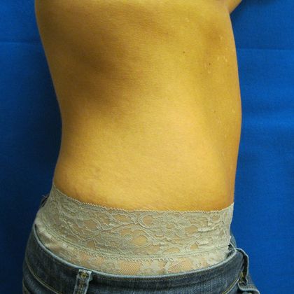 Tummy Tuck: Case 6 - After