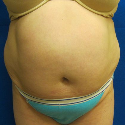 Tummy Tuck Case 7 - Before