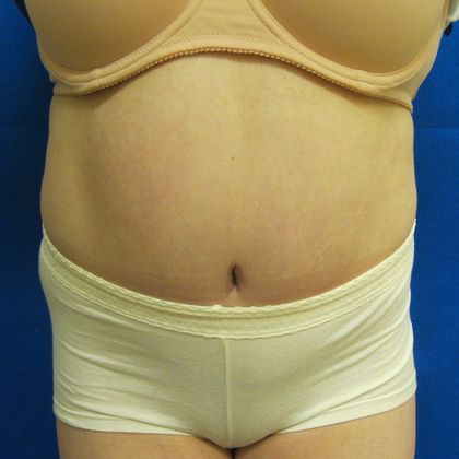 Tummy Tuck Case 7 - After