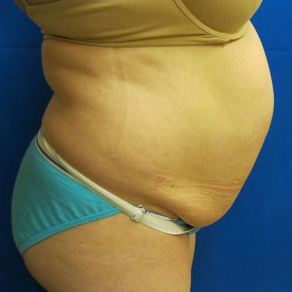 Tummy Tuck: Case 7 - Before