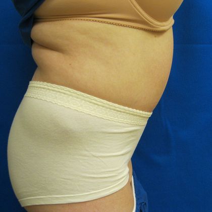 Tummy Tuck: Case 7 - After