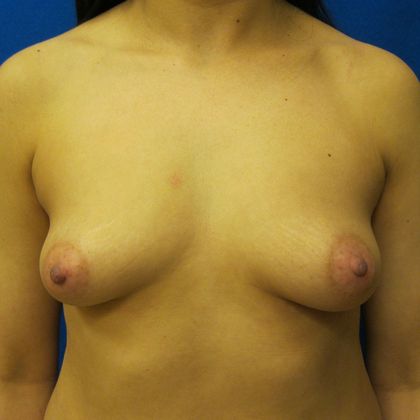 Breast Augmentation Case 12 - Before