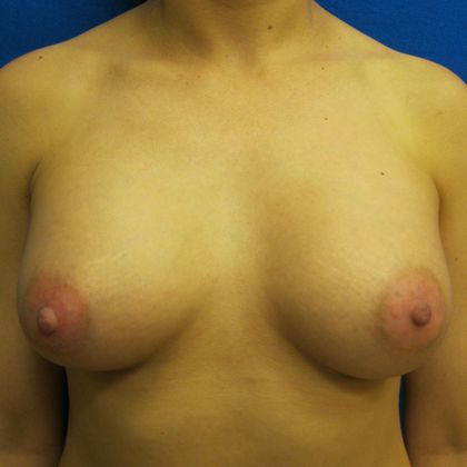 Breast Augmentation Case 12 - After