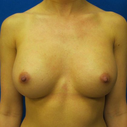 Breast Augmentation Case 5 - After